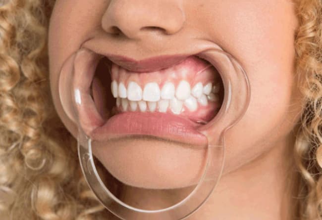 Impression Kit - Dental Photo with Stretcher